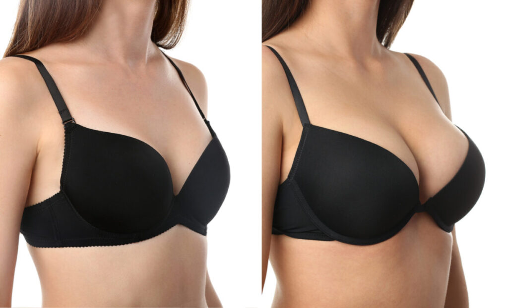 Breast Augmentation