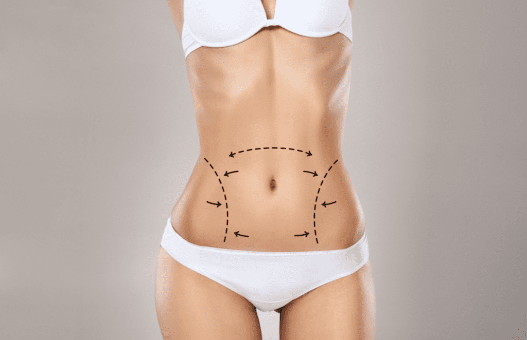 Tummy Tuck